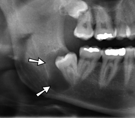Dentigerous Cyst (Follicular Cyst)