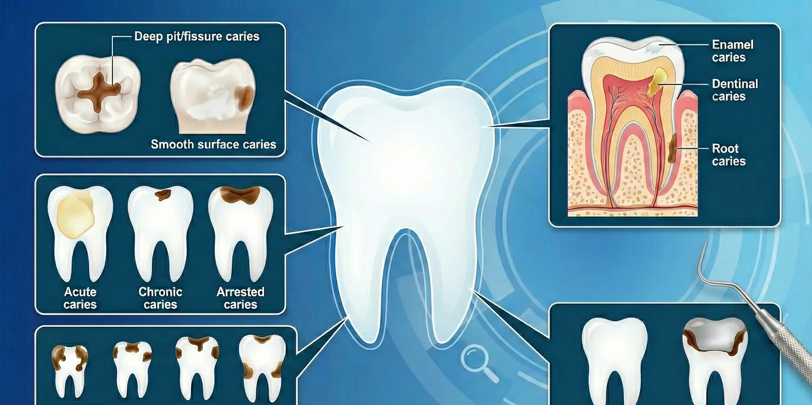 Classification Dental Caries