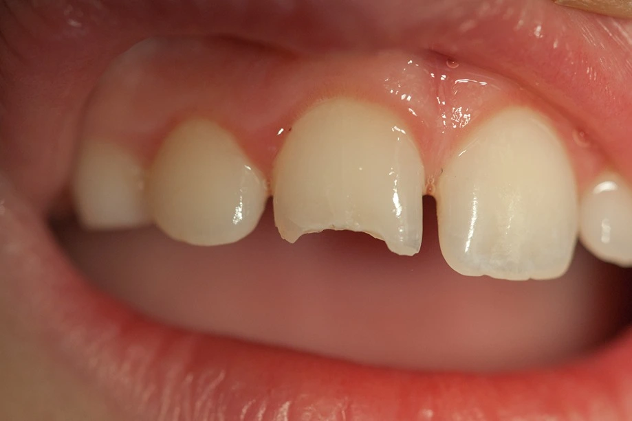 Uncomplicated Crown Fracture (Ellis Class I and Class II Fracture)