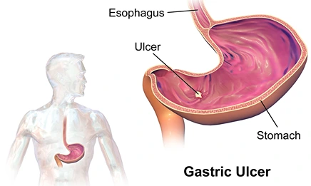 Peptic Ulcer Disease