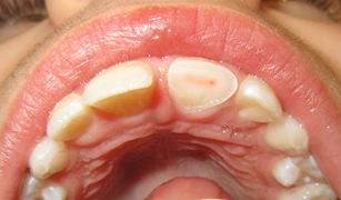 Complicated Crown Fracture (Ellis Class III Fracture)