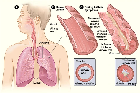 Respiratory Distress: Acute Asthmatic Episode