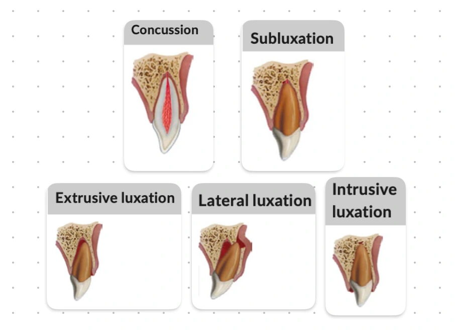 Luxation Injuries (Injuries to the Periodontal Tissues)
