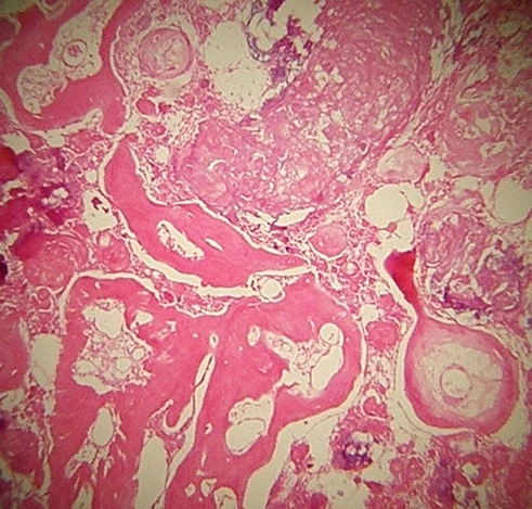 Calcifying Odontogenic Cyst (Gorlin's cyst)