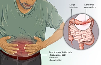 Irritable Bowel Syndrome (IBS)