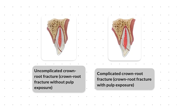 Crown-Root Fracture