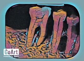 Lateral Periodontal Cyst