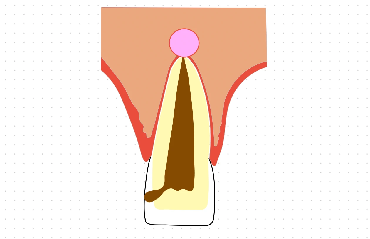 Periapical Cyst (Radicular, Apical periodontal or Root end Cyst)