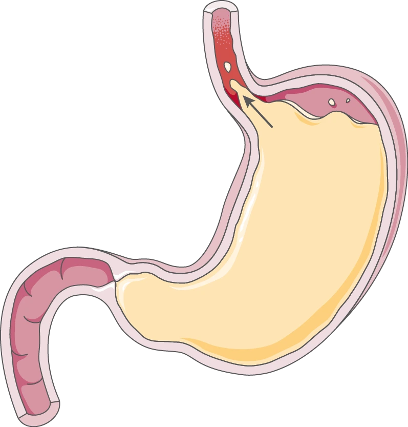 Gastroesophageal Reflux Disease (GERD)