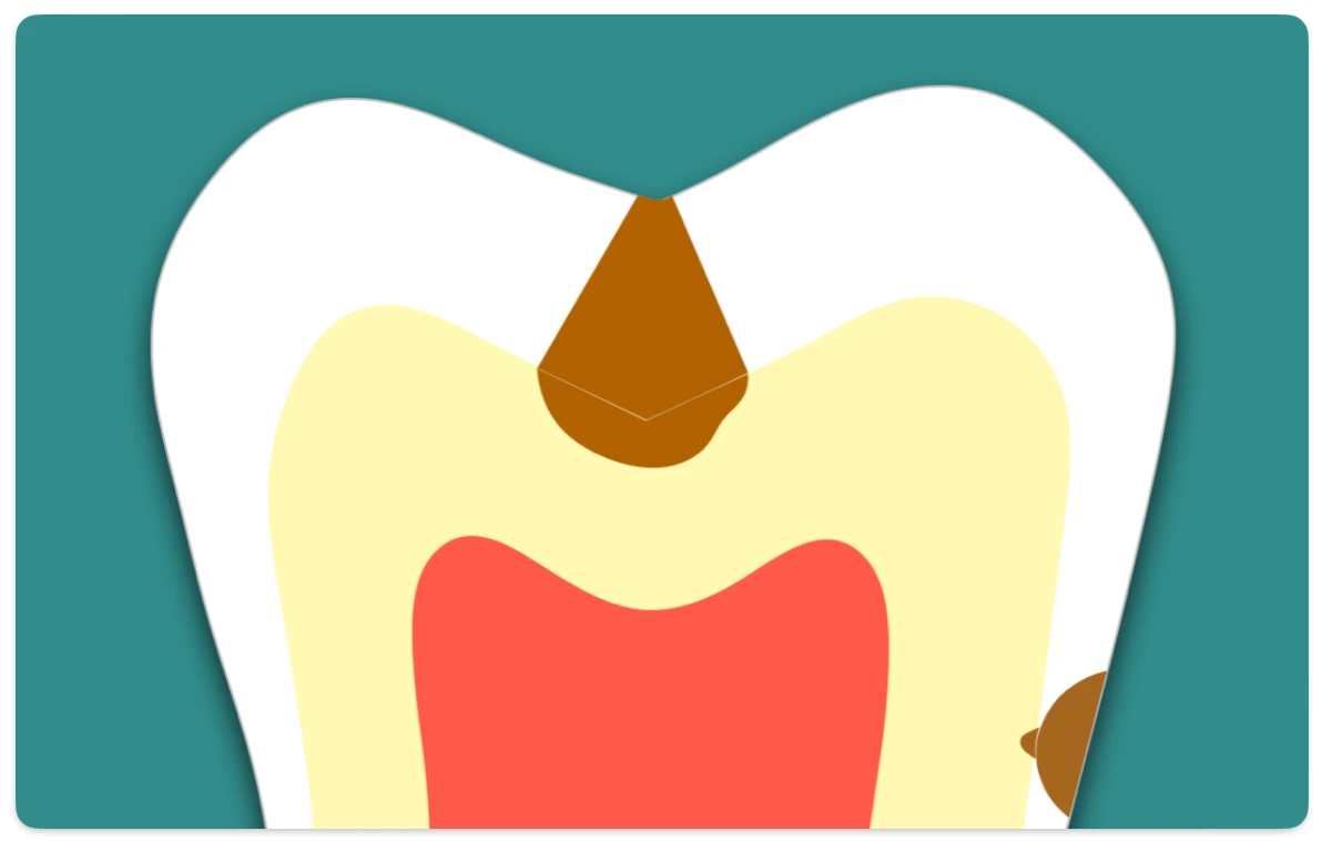 Histopathology : Zones of Enamel and Dentinal Caries