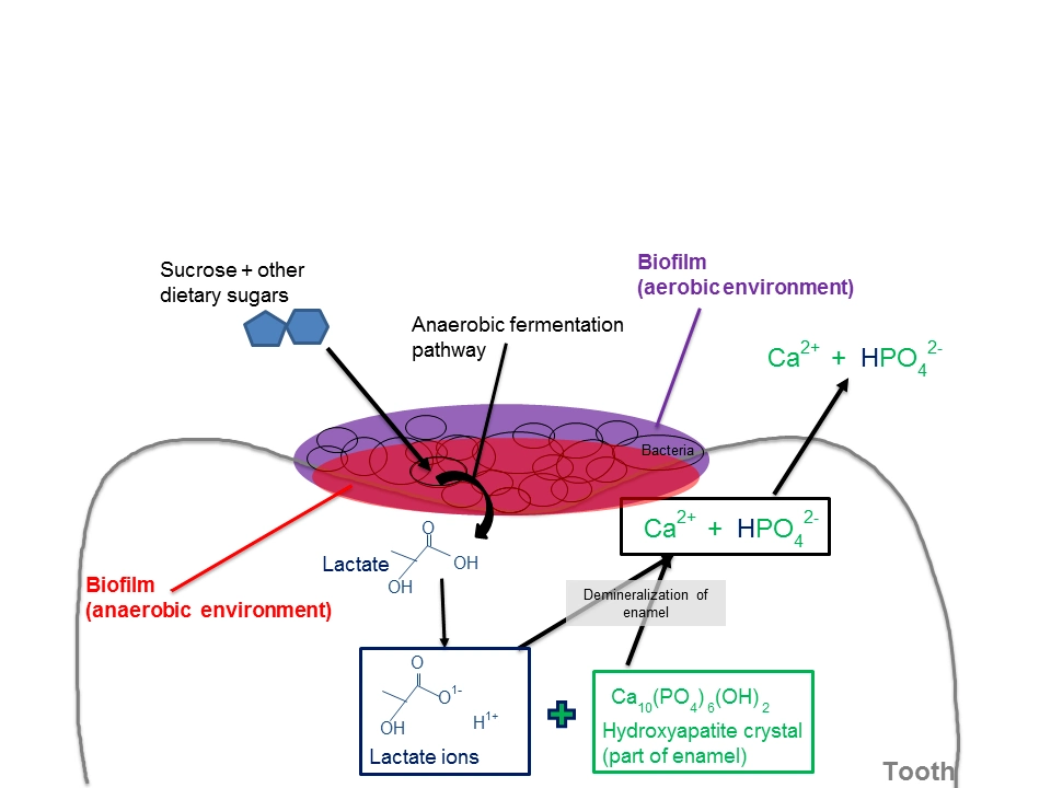 The Caries Process : Development and Progression