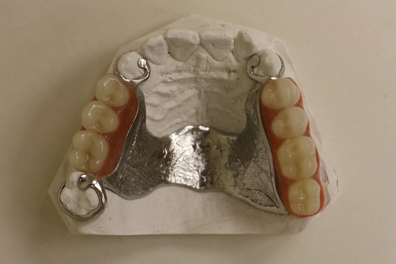Maxillary Major Connectors