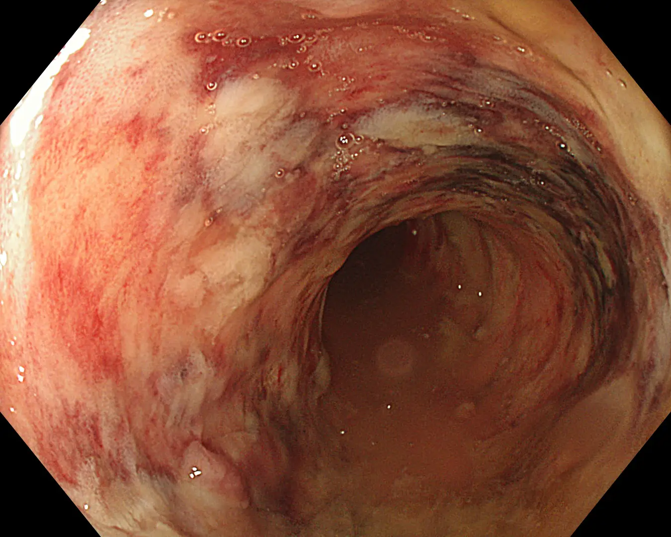 Ulcerative Colitis