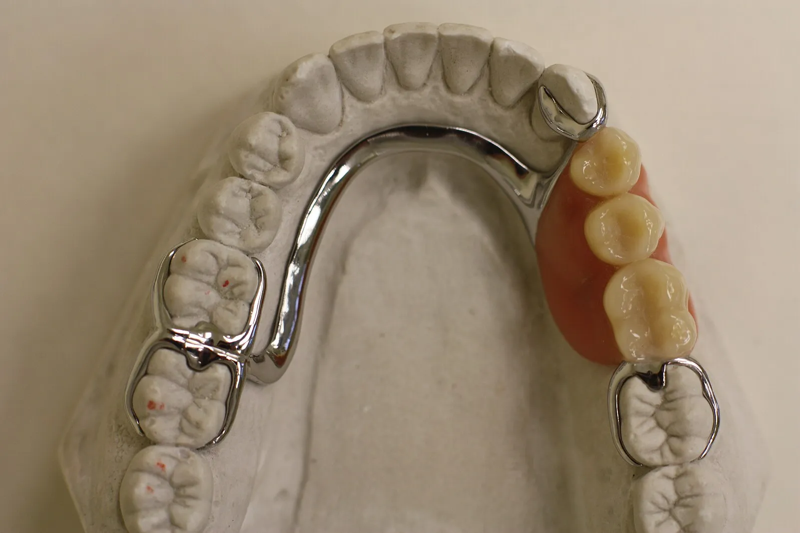 Mandibular Major Connector