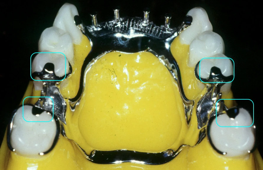 Occlusal Rests & Rest Seats