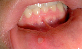 Recurrent Aphthous Stomatitis
