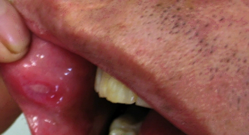 Bechet's disease (Bechet Syndrome)