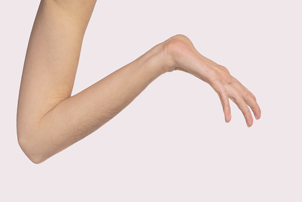 Marfan/Marfan-Achard syndrome