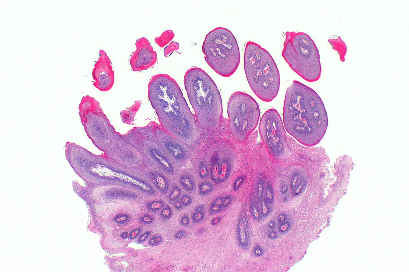 Squamous Papilloma