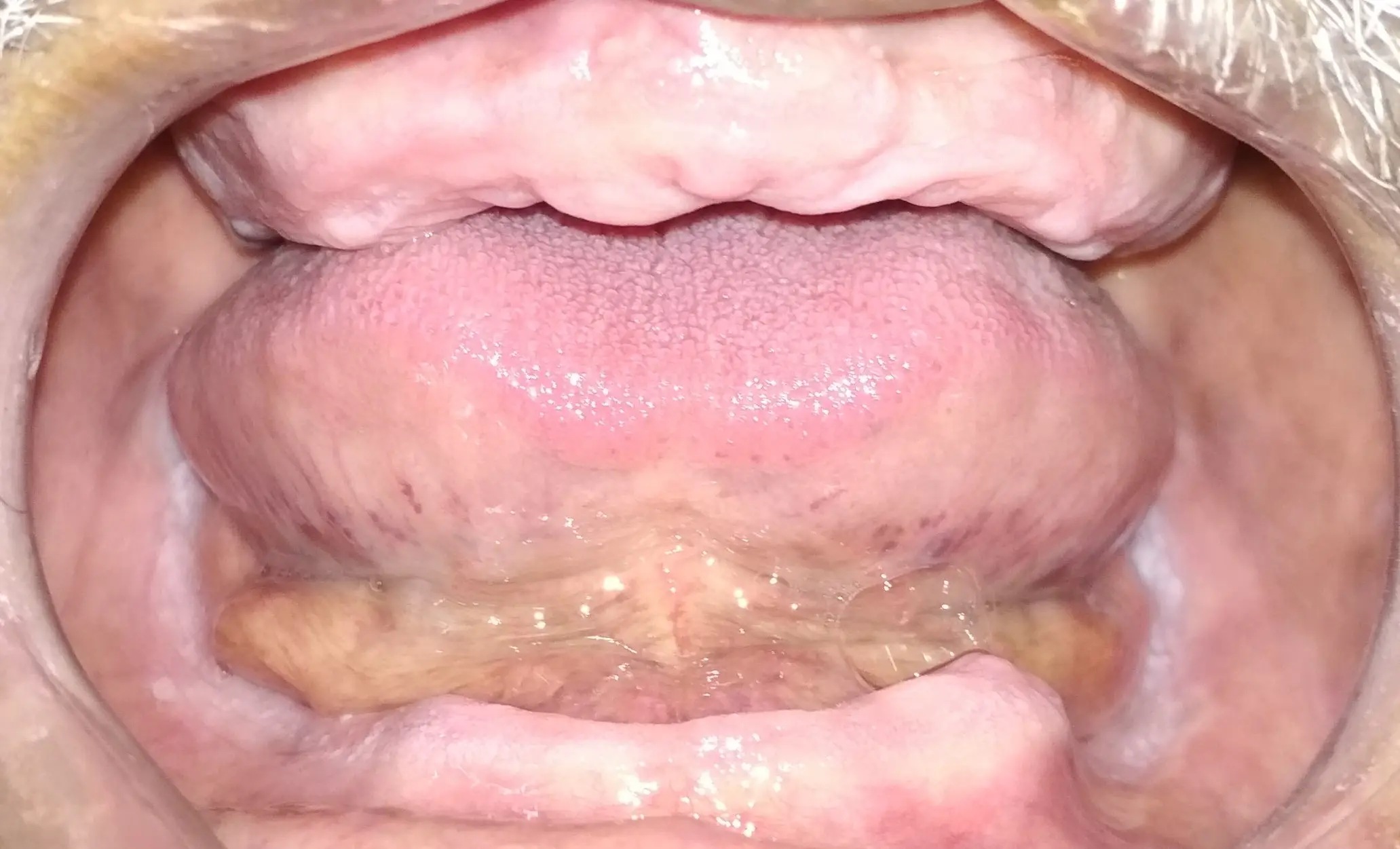 Residual Ridge Morphology : Classification