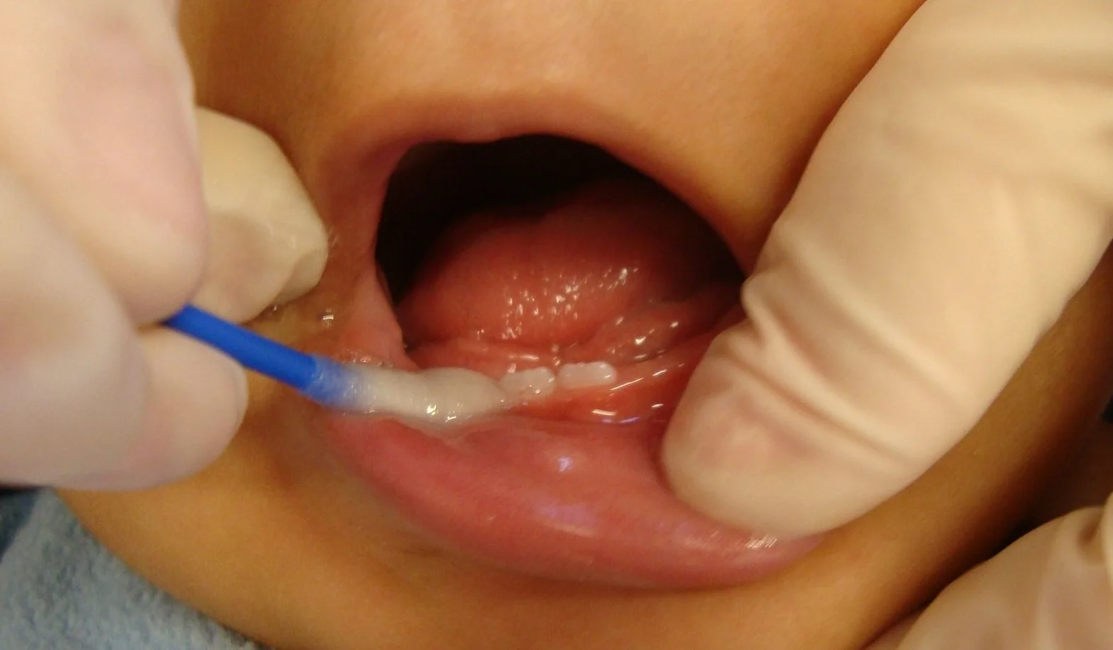 Topical Fluoride Application