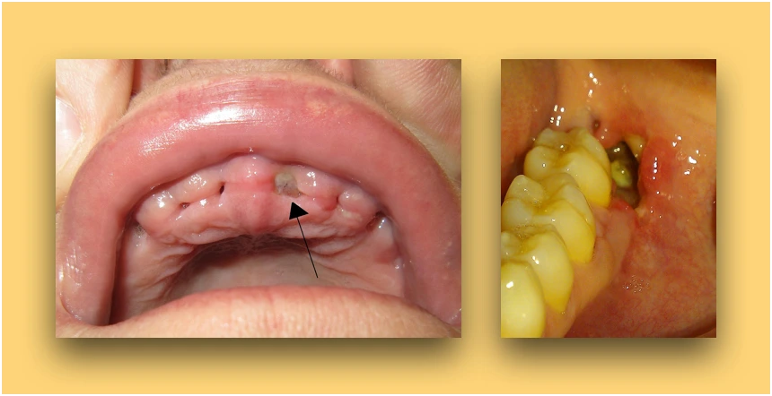 Dry Socket (Alveolar Osteitis)