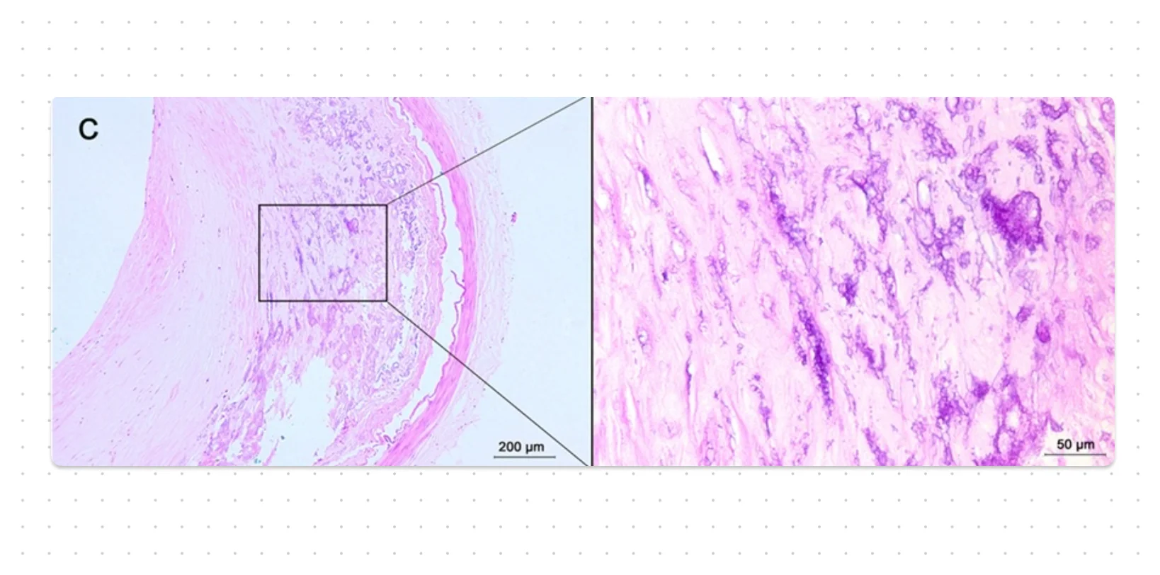 Pathologic Calcification