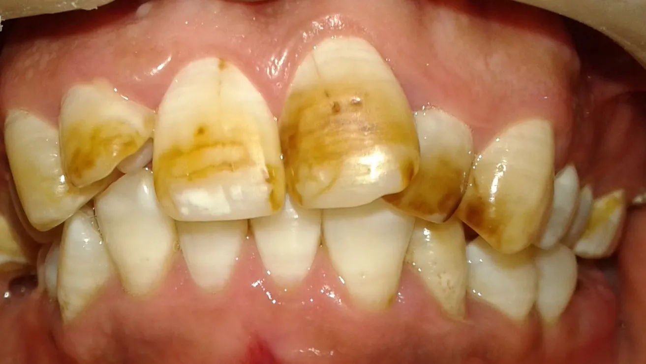 Dental Fluorosis