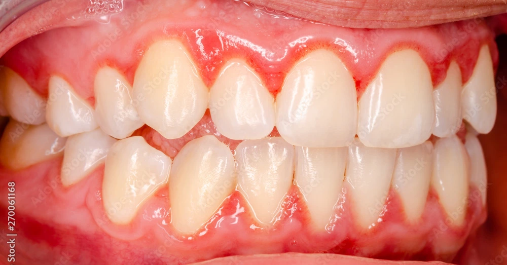 Stages of Gingivitis