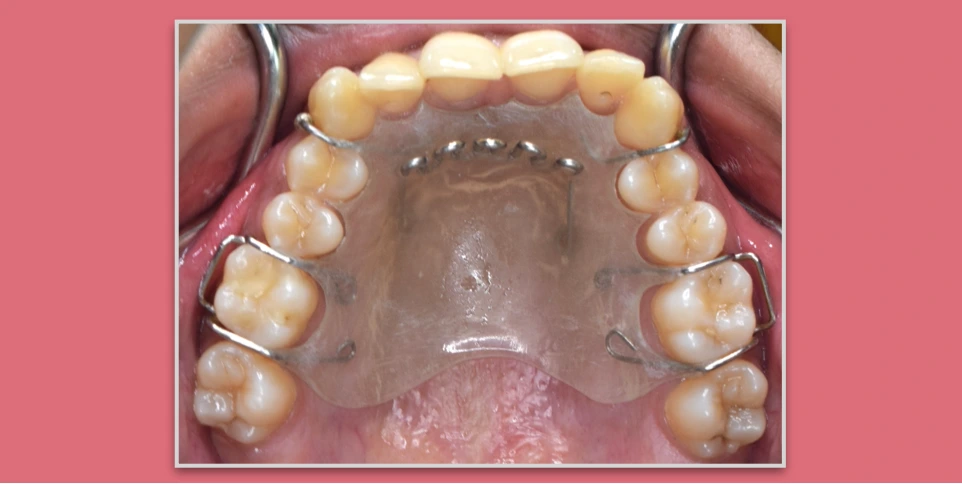Palatal Crib Appliance