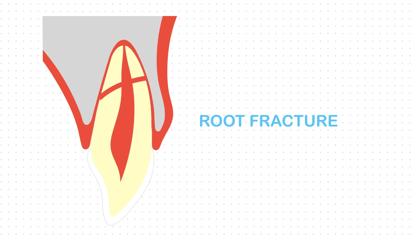 Root Fracture