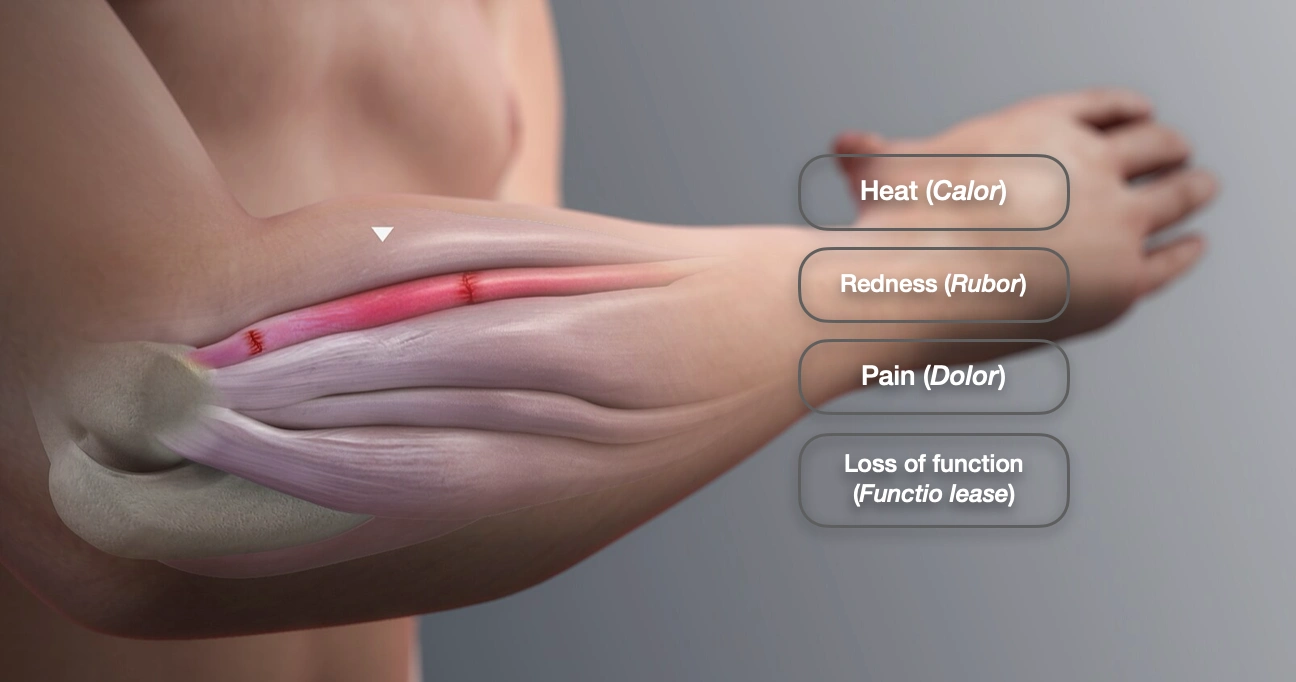 Inflammation: Introduction