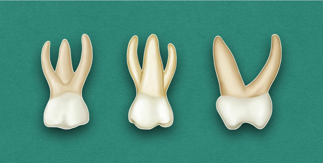 Primary Maxillary First Molar