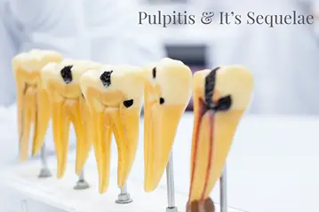 Pulpitis & It's Sequelae : A Clinical Approach