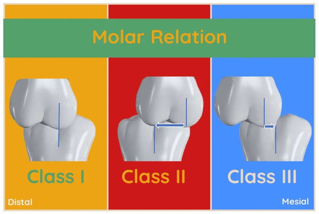 Angle's Classification of Malocclusion