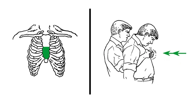 Chest thrust against choking