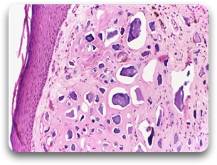 Multiple amorphous basophilic calcium deposits in the dermis.