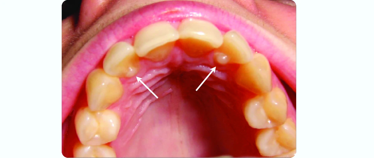 Tubercle on upper lateral incisor