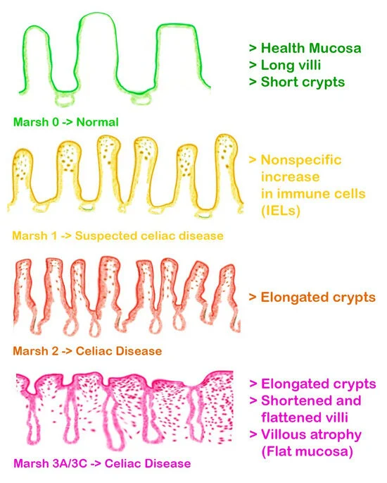 Marsh Classification of Celiac Disease