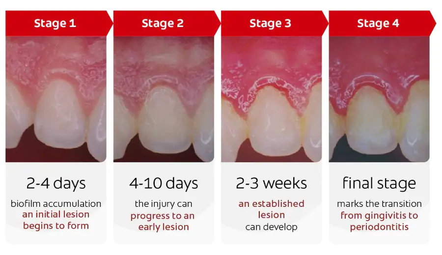 Stages of Gingivitis