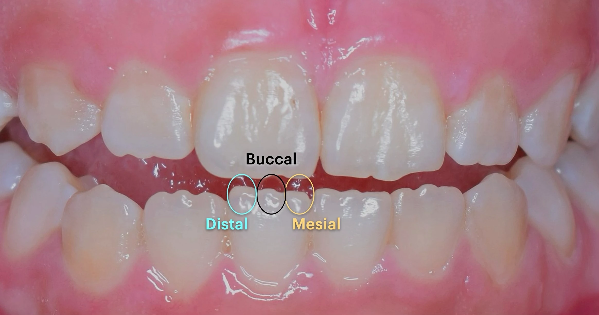 Mamelons: Mesial, Buccal, Distal
