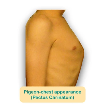 Pectus carinatum Severe case of pectus carinatum (pigeon chest)