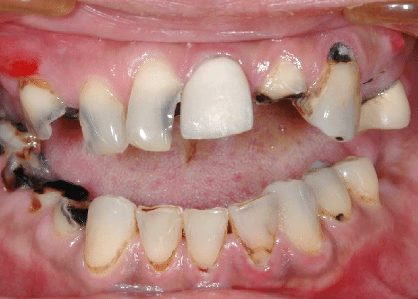 Rampant caries due to xerostomia caused by radiation therapy 